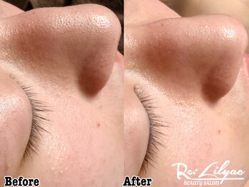 リリアック(Re:Lilyac)/Re:ilyac#毛穴洗浄