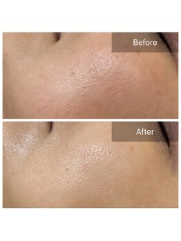 ステラルーテ(Stella lute)/ハーブ施術3回で毛穴が！