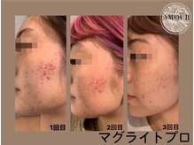 アムール 麻布十番(Amour)/光フェイシャル☆ニキビ肌ケア