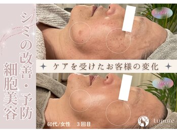 ルプレ(Lupure)/ハーブピーリング3回目