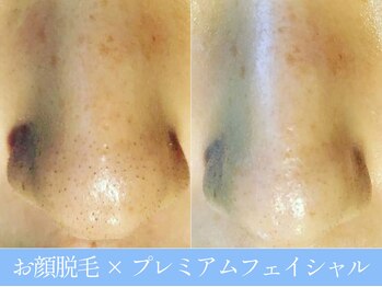 オーシャンブルー 大分店(OCEAN BLUE)/顔脱毛×プレミアムフェイシャル