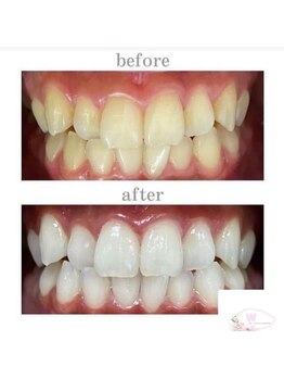 ホワイトニングショップ 本厚木店/【ビフォーアフター】10回