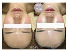 ストーリー 沼津店(STORY)/ハーブピーリング専門店STORY