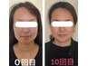 【頭も頬骨もエラも丸ごとギュ！】平日のみ頭蓋骨矯正＋小顔矯正65分　9500円