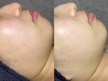 アンドミー 西宮北口店(&me)/ララピール【美白/赤み改善】