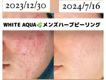 ホワイトアクア 柏店(WHITE AQUA)/メンズピーリング/赤み/乾燥