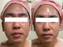 エステサロン ジョアアンジェ(joie ange)/レッドショット1回