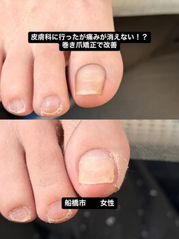 巻き爪じゅん 千葉駅前店/介護中に多い巻き爪トラブル