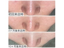 サロンリシェ(salon riche)の雰囲気（【30代女性】赤み・テカリ・角栓/10ヶ月/エステ13回＋ホームケア）