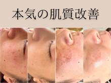 ミーツ(Meets)の雰囲気（毛穴、ニキビ、くすみ、シミ、しわ…お肌悩みお聞かせください）