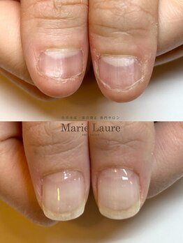 マリーロール 梅田店(Marie Laure)/自爪育成/深爪矯正/ネイルケア