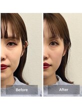 ヴィーライン 恵比寿本院(VeLine)/お客様Before After/小顔効果