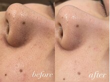 フェイン 青山店(fein.)/頑固な毛穴汚れに♪