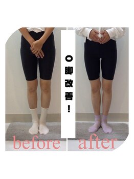 スタイルラボ高松/O脚矯正の効果♪