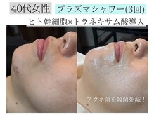 アースコアフュールボーテ ひたち野うしく店(EARTH coiffure beaute)/プラズマシャワーでニキビケア