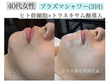 アースコアフュールボーテ ひたち野うしく店(EARTH coiffure beaute)/プラズマシャワーでニキビケア