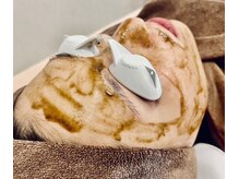 ハーブピーリング8800円ニキビ・跡にお悩みの方オススメです。