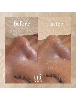 ウリ(uli beauty)/比較写真