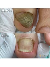 巻き爪補正店 大分店