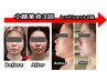 話題の脂肪分解美容液レモンボトル導入！たるみ・二重顎撃退！30分