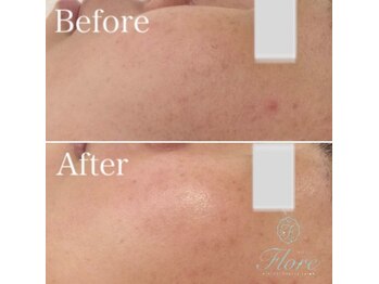 フローレ 豊田店(Flore)/お肌悩み別フェイシャル