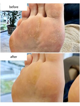 ケアプラス(care plus)/足裏角質ケア