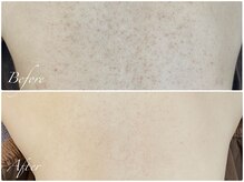 小さなプツプツにもハーブピーリング【ハーブピーリング・横浜