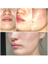 ジョンミー(JONMEE)/ニキビケアで毛穴・肌質改善◎