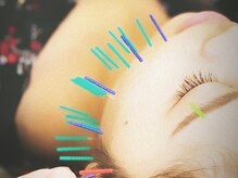 アロエベル(aloe Belle)/美容鍼