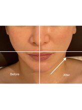アリュール(Allure)/フェイシャル引き上げ