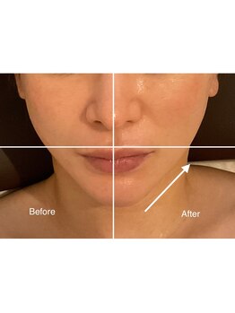 アリュール(Allure)/フェイシャル引き上げ