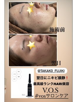 アローナ(ARONA)/VOSサロンケア！