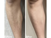 ヴィアス(vias)/膝下脱毛before→after