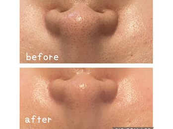 ルミナ(Lumina)/ハイドロフェイシャル★毛穴洗浄