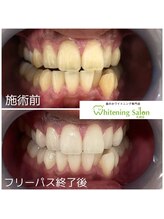 ホワイトニングサロン 札幌店/【ホワイトニング】#札幌#大通り