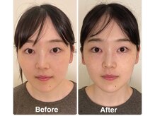 かつらはりきゅう 小児しん/お得な美容鍼と鍼灸施術のセット