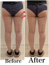 スペチアーレ 夙川/脂肪冷却でお尻をキュッと小さく