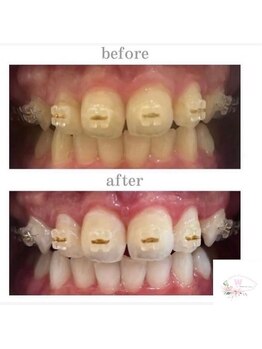 ホワイトニングショップ 本厚木店/【矯正中でも大丈夫】