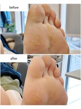 ケアプラス(care plus)/足裏角質ケア