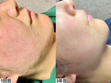 アンドミー 池袋(&me)/肌状態に合わせたメニューを提案