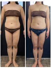 ラナ(Lana)/船橋市初☆セルライトゼロ2