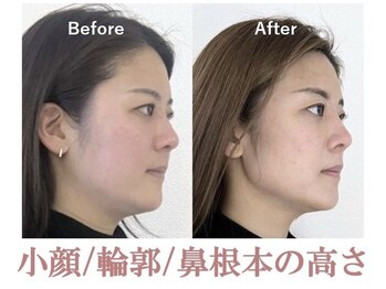 ラプリ 盛岡店(Raplit)/隆鼻＋輪郭矯正40分10回