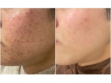 ハクビューティー(HAKU BEAUTY)/色素/ニキビ