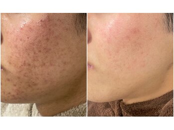 ハクビューティー(HAKU BEAUTY)/色素/ニキビ