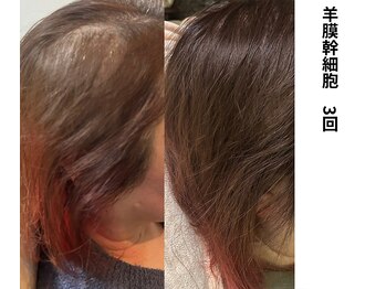 ボニータ(Bonita)/【頭皮Lit】ヒト羊膜幹細胞