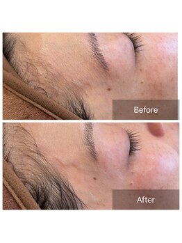 ライエ(Raie)/フェイスワックス脱毛