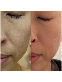 フォーケア(4Care)/プロセル肌質改善トリートメント