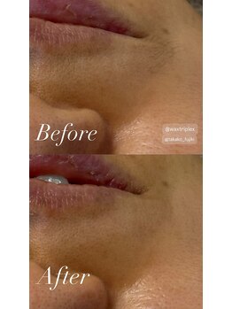 パタティパタタ(PatatiPatata)/お口周りの脱毛も!