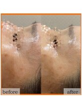 エステ ココ 土気店(Esthe CoCo)/#ハーブピーリング#剥離無し