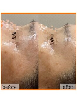 エステ ココ 土気店(Esthe CoCo)/#ハーブピーリング#剥離無し